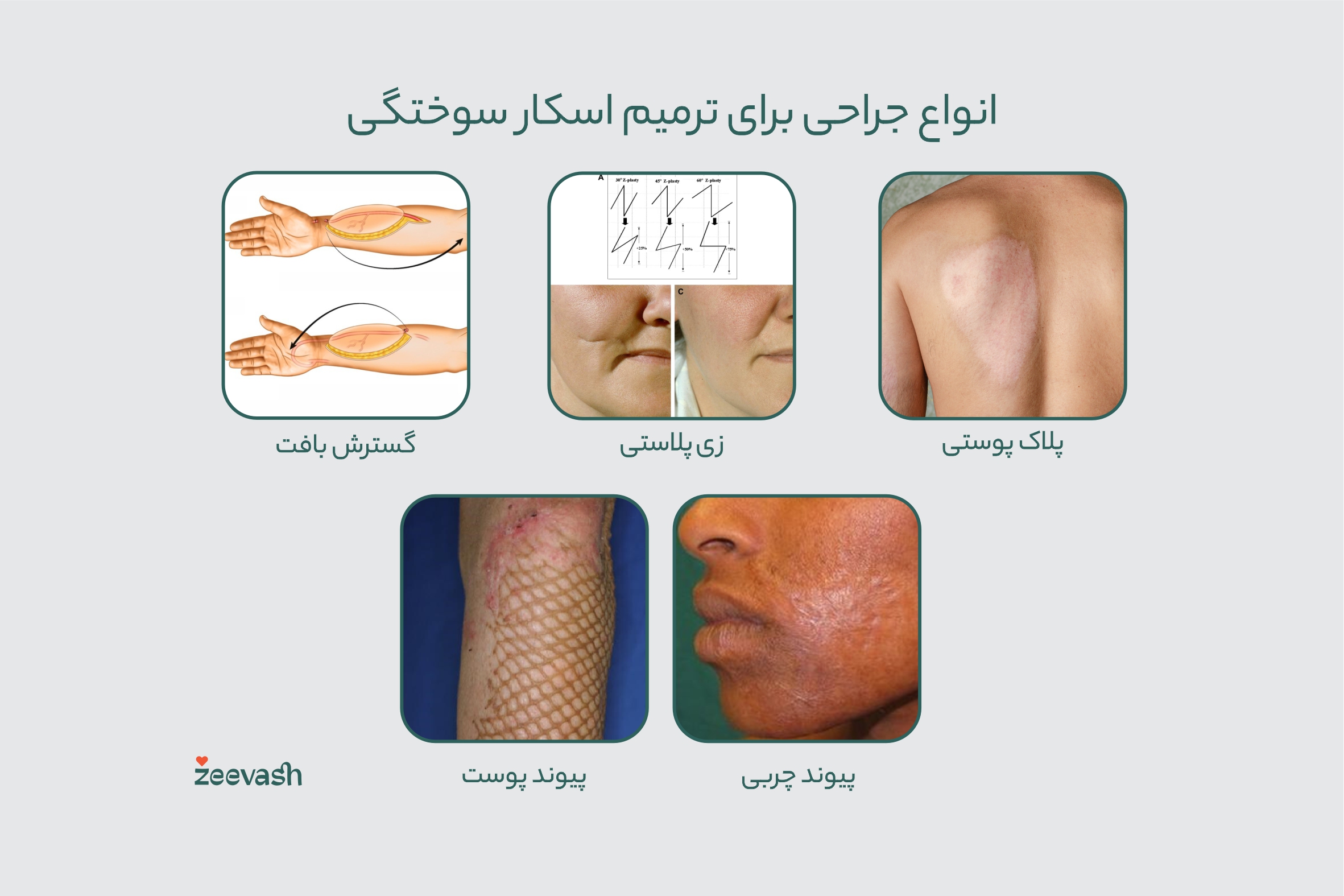 انواع جراحی برای ترمیم اسکار سوختگی